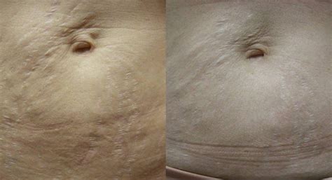 Stretch Mark Treatment Results Dm Cosmetic And Wellness