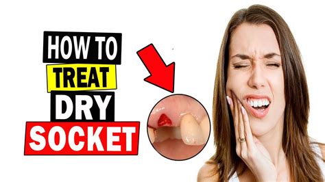 How To Treat A Dry Socket Fast At Home Home Remedies For Dry Socket