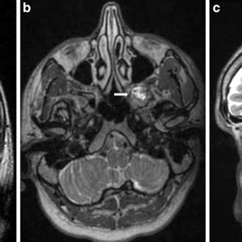 Left Temporal Pole Encephalocele In A 29 Year Old Man With Temporal