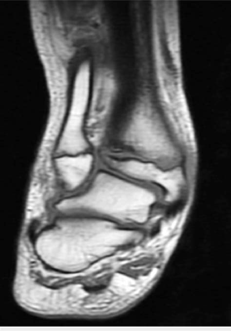 Mri Of Right Ankle Joint Coronal Section Showing Ankle Valgus