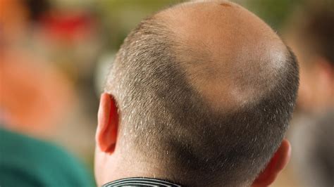 How Balding Became Big Business Daily Telegraph