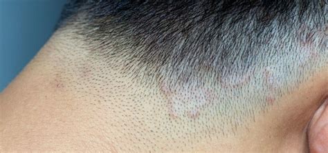 Ringworm Of The Scalp Causes Symptoms Treatment