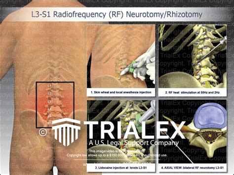 L3 S1 Radiofrequency Rf Neurotomyrhizotomy Trialexhibits Inc