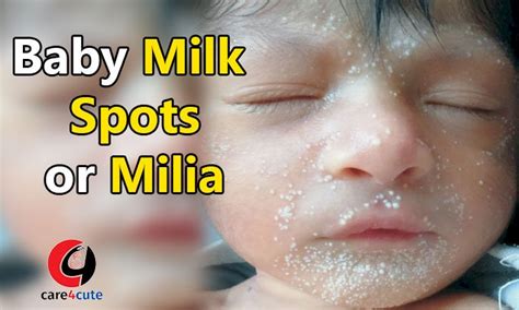 Baby Milk Spot Or Milia