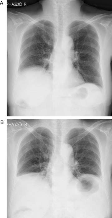 A Chest X Rays Show Right Diaphragmatic Eventration B Chest X Rays