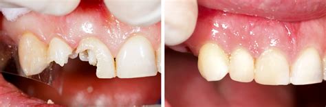 Jul 11, 2020 · a dental filling is a dental procedure used to restore part of a tooth that has been damaged by decay. Tooth Filling | Dental Fillings | The Tooth Company