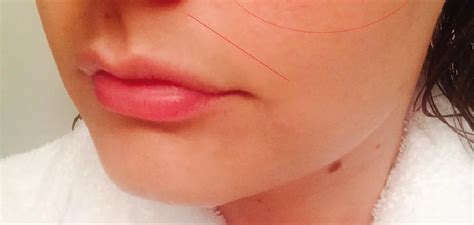 How To Cover Melasma On Upper Lip With Makeup 5 Quick Steps 2024