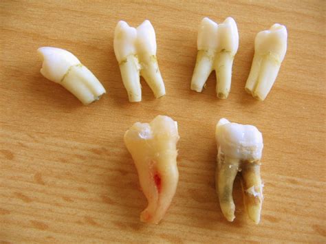 How To Stop Wisdom Tooth Pain Until You Can Get To The Dentist Hubpages
