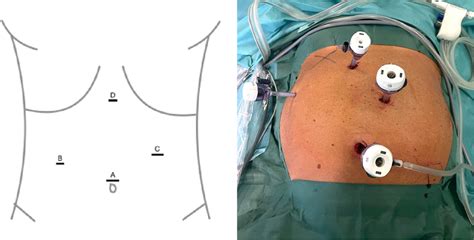 Port Placement For Laparoscopic Cholecystectomy A 10 Mm Camera