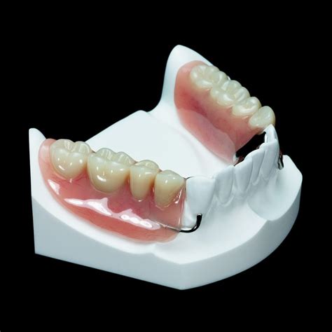Im 20 Partial Mandible With 2 Locators Paradigm Dental Models