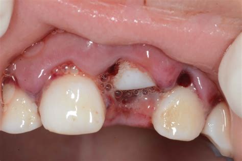 Dental Trauma In Children Types Of Injuries And Treatment Stitches