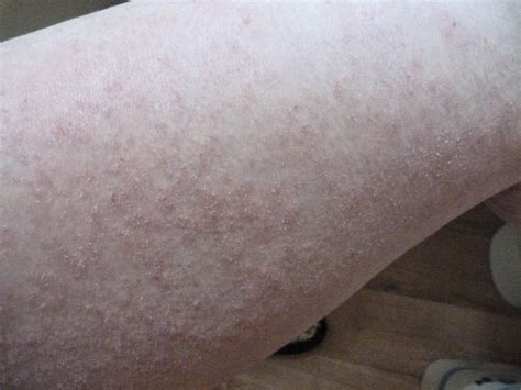 I Have Eczema 135 Month Photos