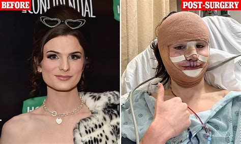 Trans Influencer Dylan Mulvaney Unveils Results Of Her Facial