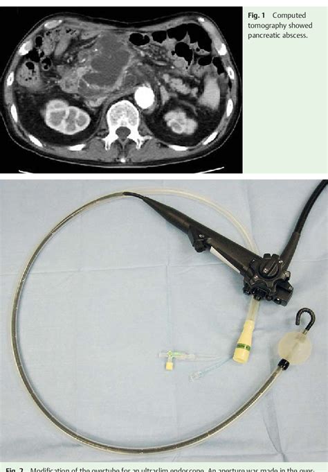 Figure 1 From Ultraslim Endoscope Assisted Therapeutic Ercp For