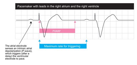 Basic Cardiac Pacing Pacemaker Functions And Settings Ecg And Echo