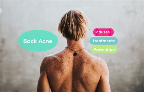 What Causes Back Acne Can It Be Prevented Acne Help Mdacne