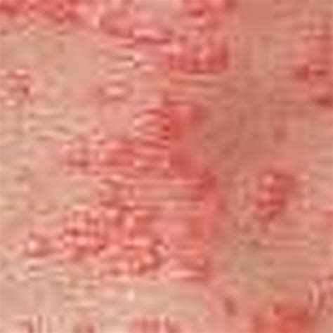 How To Recognize And Treat Scabies Healthy Living