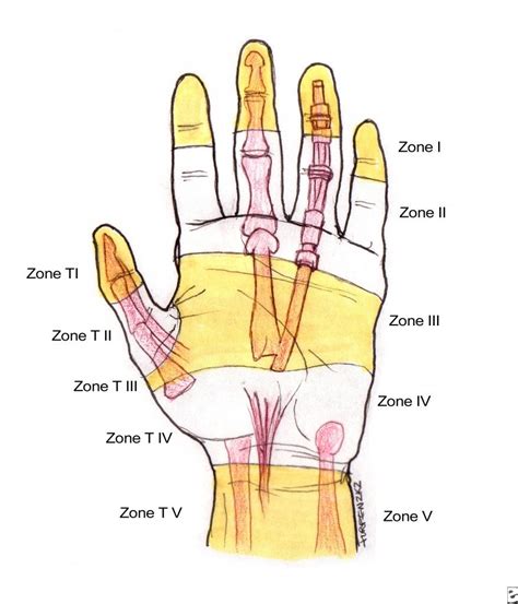 Flexor Tendon Zones Of Hand Bone And Spine Hand Therapy Infant