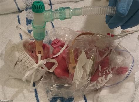 Doctors Rescued A 11lb Baby By Keeping Her Warm In Plastic Daily