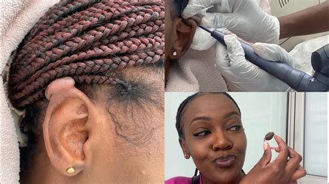 Keloid Removal In Nairobi How I Got Rid Of My Keloid Permanently