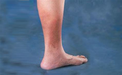 Causes Of Skin Discoloration On Ankles Chicago Vein Care