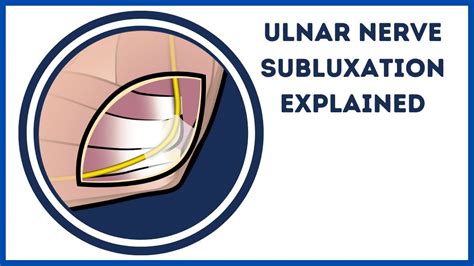 Ulnar Nerve Subluxation Snapping Ulnar Nerve Explained Youtube