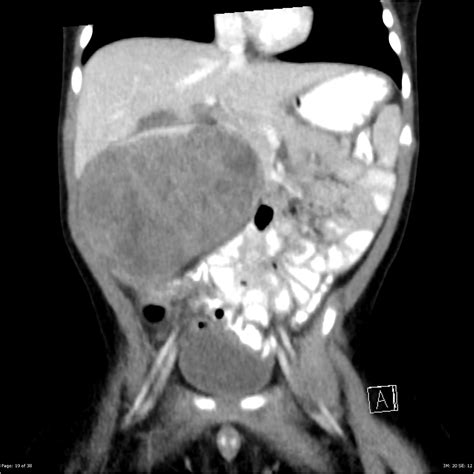 Renal Rhabdoid Tumor Image