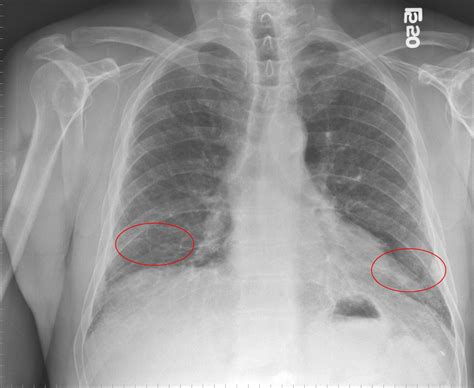 Pulmonary Fibrosis Alveolitis Fibrosing Hamman Rich Syndrome