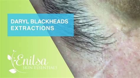 Extractions Of Blackheads And Cyst On Daryl Youtube
