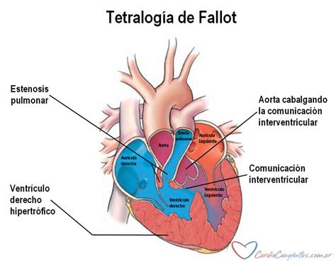 Tetralogia De Fallot Seqüelas