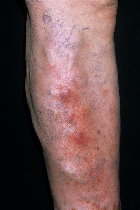 Superficial Thrombophlebitis Photograph By Dr P Marazziscience Photo