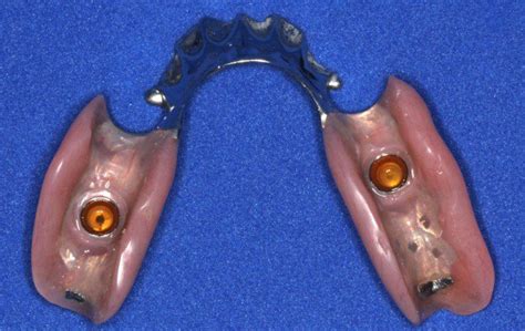 Implant Over Partial Back Female Dental Implant Center