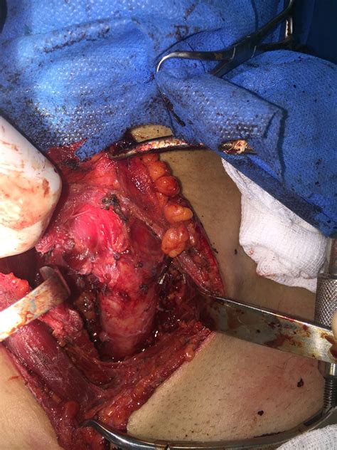 Total Thyroidectomy And Lymph Node Dissection For Papillary Thyroid