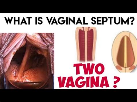 Double Vagina What Is Vaginal Septum Youtube