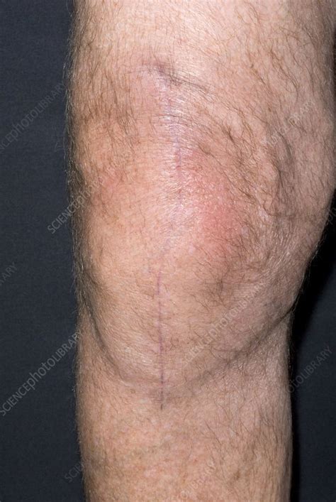 But never fear, a tattoo artist my total replacement was in my right knee. Knee replacement scar - Stock Image - M332/0197 - Science ...