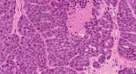 Basaloid Squamous Cell Carcinoma Of The Larynx Atlas Of Pathology
