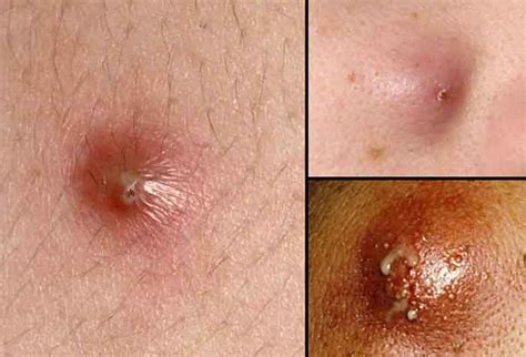 Boil Vs Pimple Differences With Pictures Boil Or Pimple