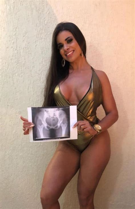 Miss Bumbum 2018 Contestants Pose With X Rays The Advertiser
