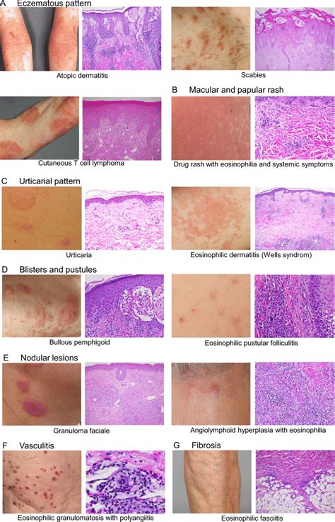 Clinical And Histological Presentations Of Dermatoses Associated With