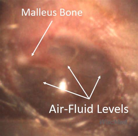 Acute Otitis Media Aom A Spectrum Of Images From Normal To Aom