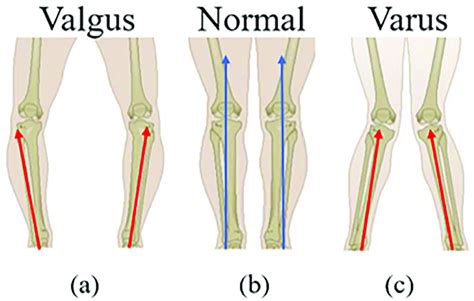 Tibia Alignment Varus 1a Normal 1b And Varus 1c Knee Red