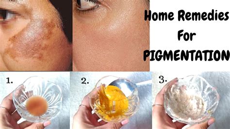 Home Remedies To Get Rid Of Pigmentation In Just 10 Days Top 3