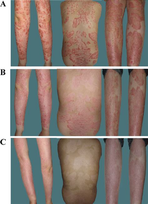 Figure 2 From Successful Treatment Of Severe Psoriatic Arthritis And