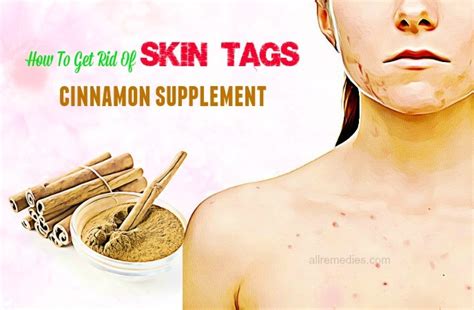 33 tips how to get rid of skin tags on neck and breasts naturally