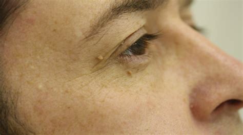 Treat unsightly skin tags in less than 60 seconds. Photos of Skin Tags on Eyelids ~ How To Remove Moles ...