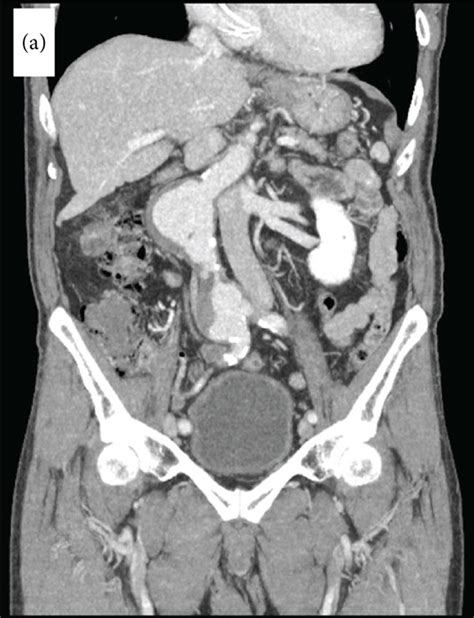 Infrarenal Abdominal Aortic Aneurysm And Left Sided Inferior Vena Cava