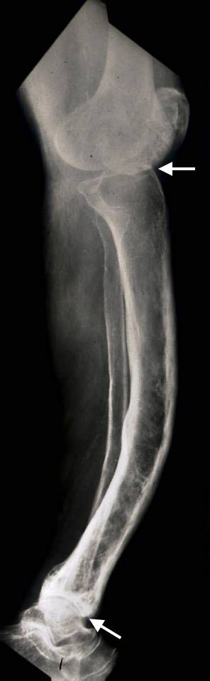 Paget disease is a localized disorder of bone remodeling that typically begins with excessive bone resorption followed by an increase in bone formation. Paget's Disease of Bone - Symptoms and Treatment ...