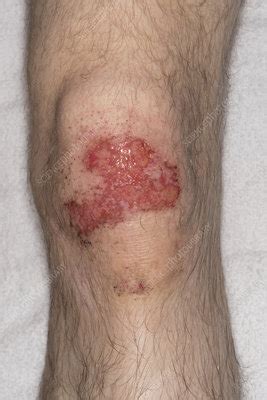 Chemical cement burn on knee - Stock Image - C039/7283 - Science Photo