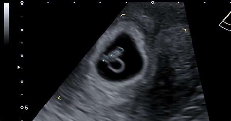 5 Week Ultrasound Scan