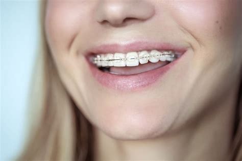 The Most Common Problems Braces Fix Heall
